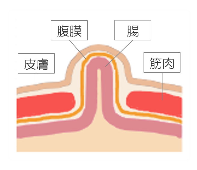 臍突出のシェーマ